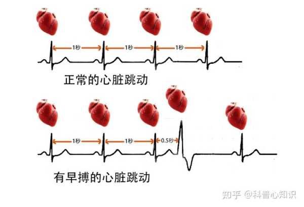 天气与心脏早搏(早搏突然就来了)