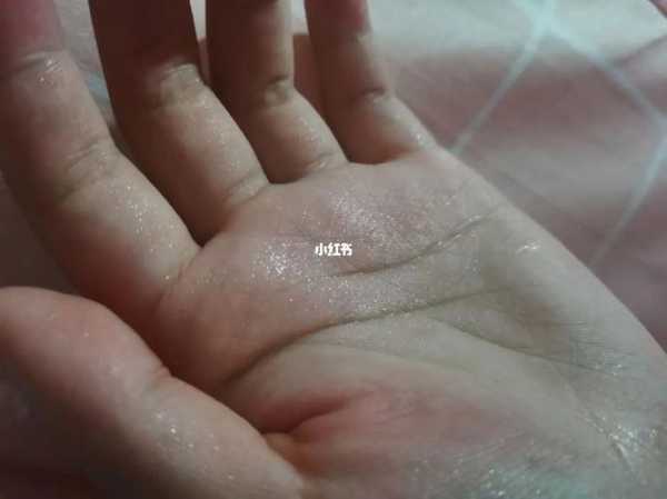 天气很热手心出汗，如何缓解这一症状？