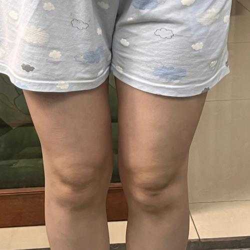 潮湿天气膝盖涨,如何缓解不适?