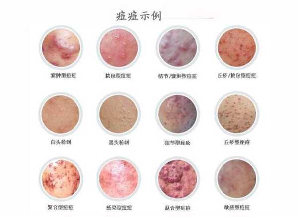 人面疮图片_如何辨别和处理_