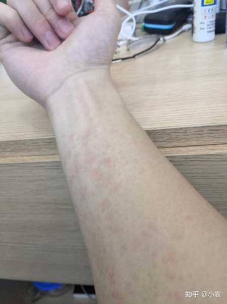 天气一热手臂丘疹,是过敏了还是被什么东西咬了