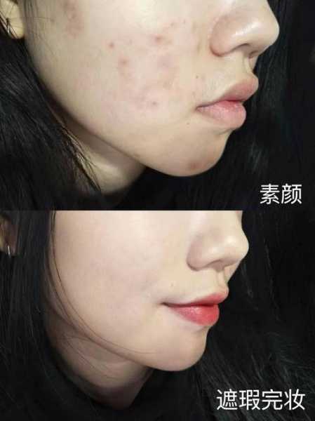 用后天气丹脸上起痘痘, 如何应对这一问题?